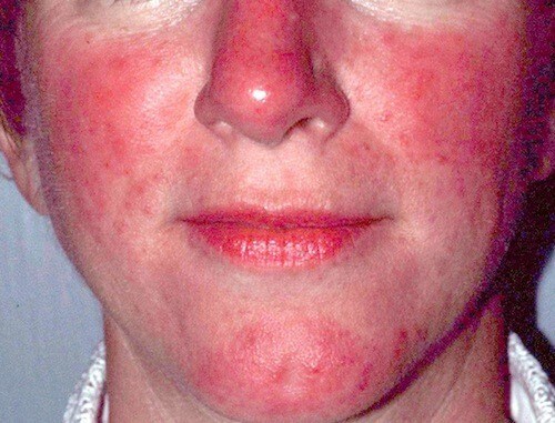 Rosacea Vs Lupus Butterfly Rash 